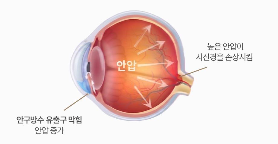 녹내장 안구